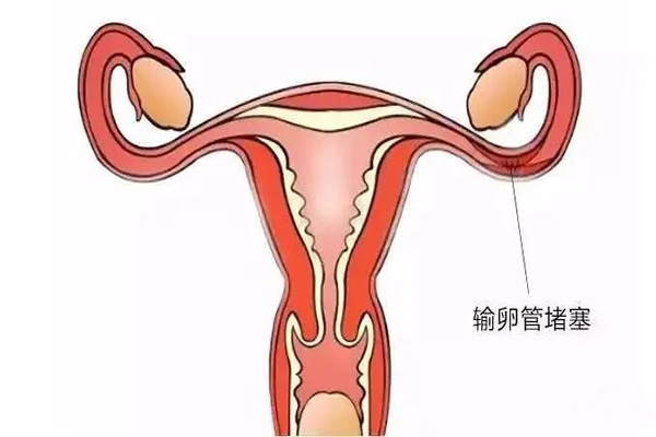 输卵管堵塞在青岛做试管能报销吗？比例是多少？
