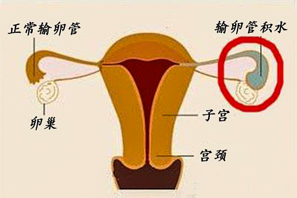 左侧输卵管粘连试管婴儿适合鲜胚移植还是冻胚移植？