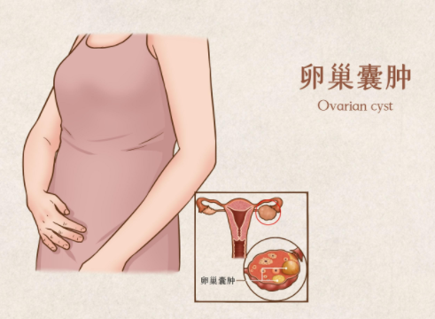 卵巢囊肿调养后可以通过试管婴儿的方式生孩子吗？