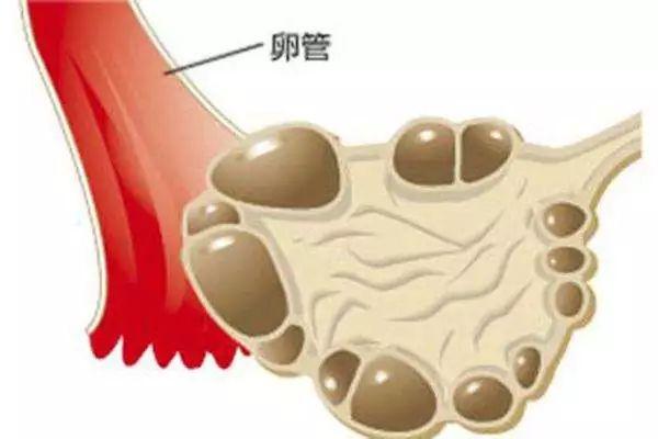 多囊卵巢综合征在潍坊做试管能报销吗？