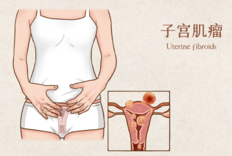子宫肌瘤在江苏省人民医院做试管的成功率有多大？