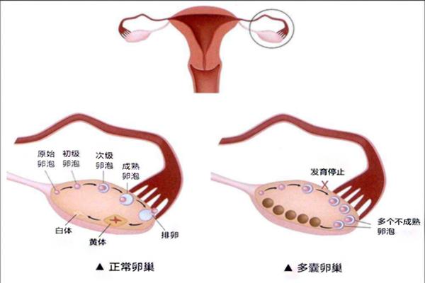 多囊卵巢综合征在哈尔滨做试管好吗？