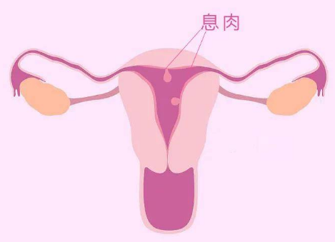 郑大二附院能为患有子宫内膜息肉的女性做试管婴儿吗？
