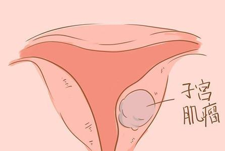 子宫肌瘤的患者去格鲁吉亚做试管婴儿是明智的选择吗？
