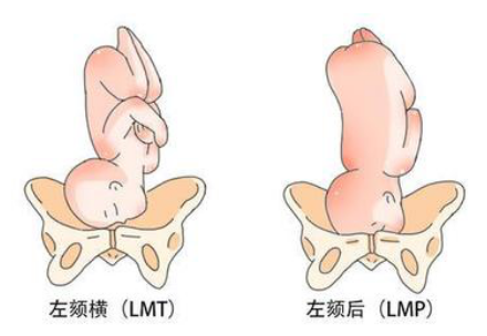 LMP胎位是正常的胎位吗？