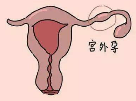 试管出现宫外孕后也有症状，试管宫外孕症状早期体征你知道几个？