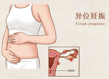 试管移植冻囊胚也会出现宫外孕的情况吗？
