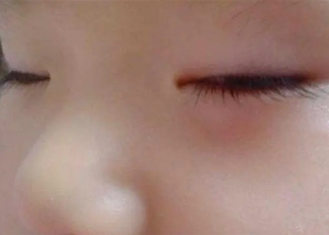 新生儿20天眼皮肿是有什么异常情况吗？