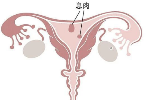 子宫息肉会影响试管移植成功着床的概率吗？