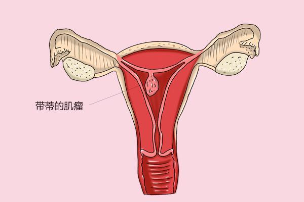 子宫肌瘤在北京做试管婴儿怎么样？