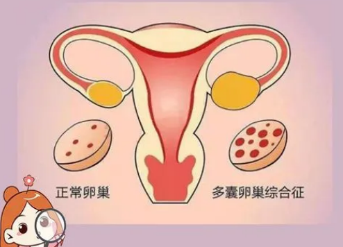 试管会引起女性患上多囊卵巢综合征吗？