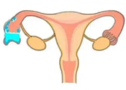输卵管积水的患者试管移植4AA囊胚成功率多高？