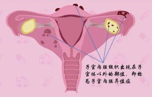 子宫内膜异位症的女性做试管婴儿的成功率如何？