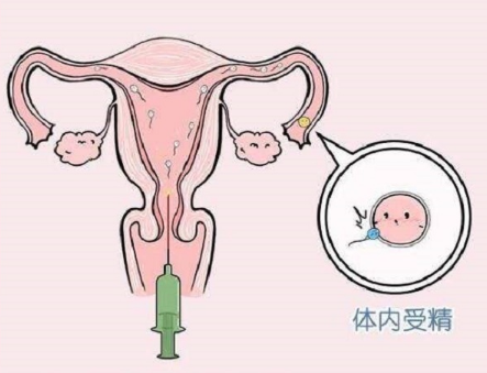 在唐山妇幼做几次人工授精才能成功怀孕？