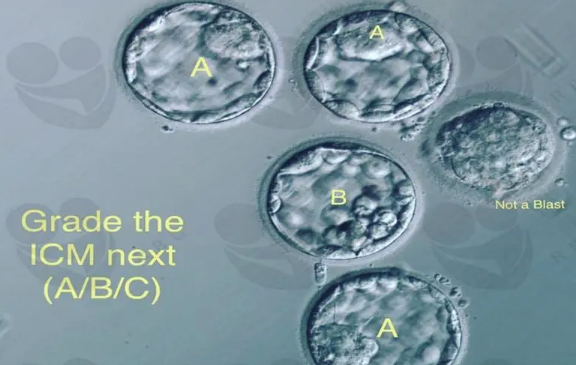试管婴儿囊胚等级4bc为什么叫黑马？看完这些案例你就知道了