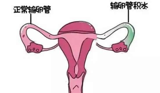 切除输卵管有什么后遗症？警惕妊娠并发症增加的情况