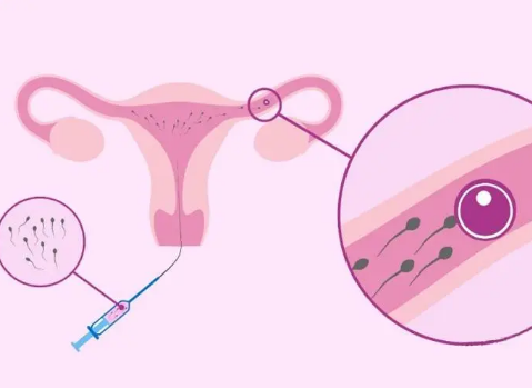 输卵管堵塞的患者做人工授精的成功率高吗？