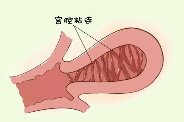 宫腔粘连的女性做试管婴儿会影响胚胎的发育吗？