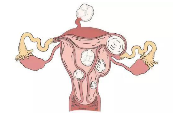 子宫腺肌瘤患者做试管移植冻胚的成功率有多高？