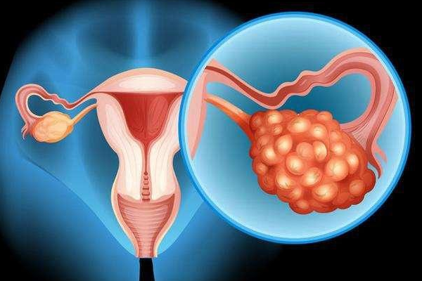 患有卵巢囊肿的女性做试管选择冻胚移植的成功率高吗？