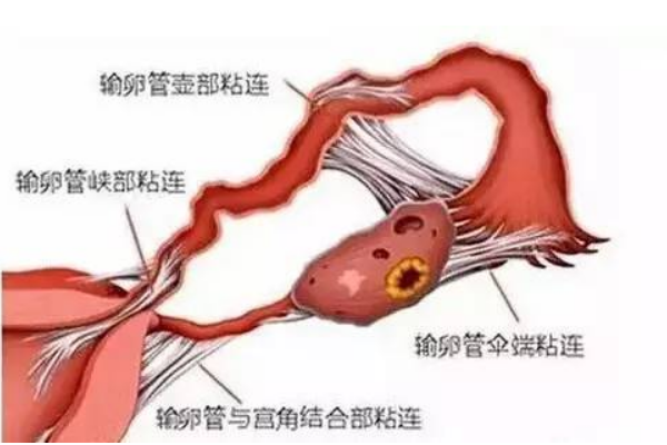 双侧输卵管粘连去上海九院做试管婴儿是明智的选择吗？