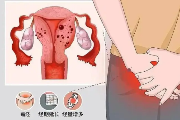 子宫腺肌症在郑州可选择这些医院治疗，郑大一附院是首选