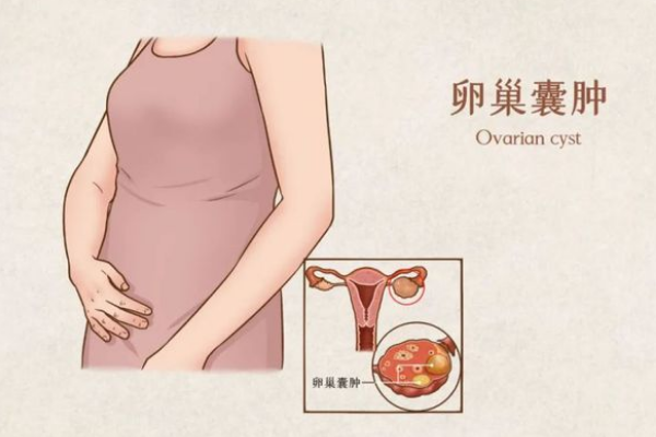 患有卵巢囊肿的女性去上海哪家医院做试管成功率高？