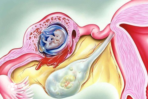 试管移植后出现宫外孕的原因是什么？