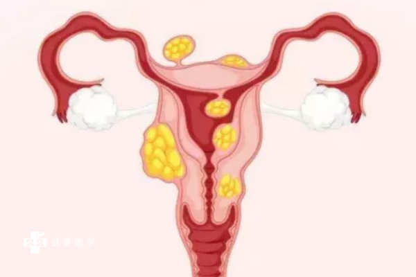 子宫肌瘤的患者做试管婴儿能移植两个胚胎吗？