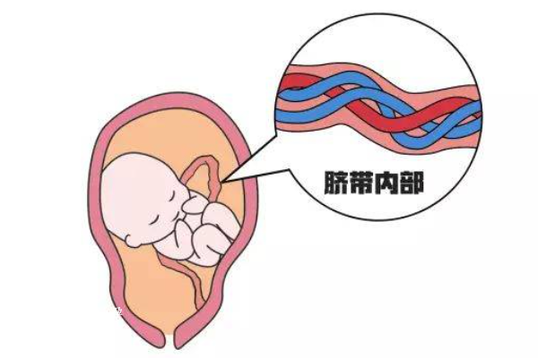 胎儿脐带螺旋和孕妈妈睡觉的姿势有关吗？