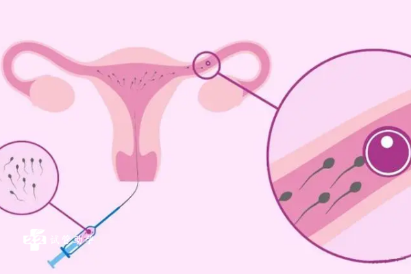 女性做人工授精之前为什么要憋尿？有什么好处？