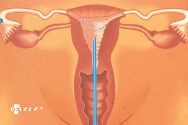 香港允许单身女性申请精子做人工助孕吗？