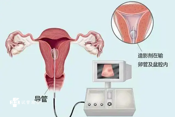 在上海红房子医院做输卵管造影有哪些流程？需要注意什么？