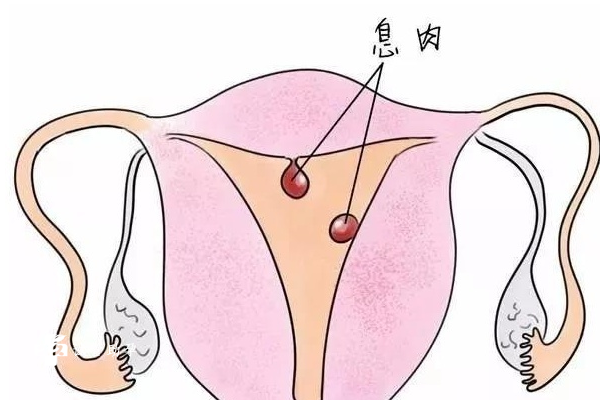 子宫内膜有息肉做试管婴儿会影响成功率吗？