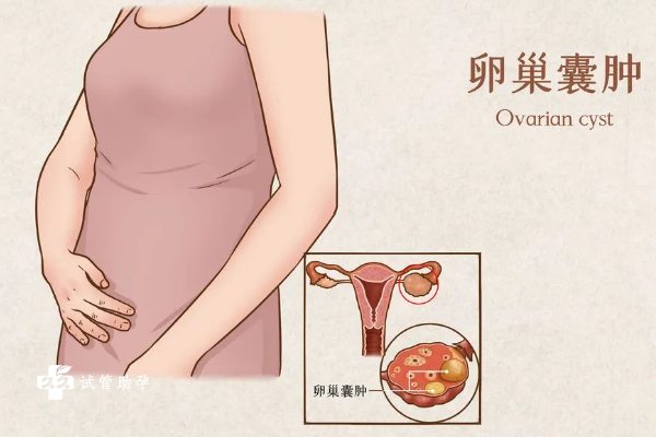 卵巢囊肿可以先调理之后再做试管婴儿吗？