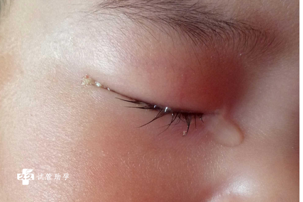 四个月的婴儿经常流眼泪是什么原因导致的？