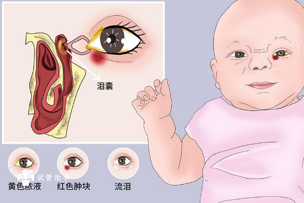 新生儿患有泪囊炎会出现哪些症状？