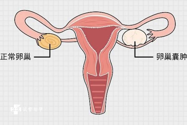 卵泡变成囊肿的三种情况一览，附预防卵泡变成囊肿的方式