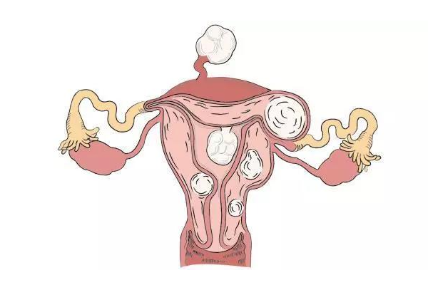 子宫肌瘤能做试管婴儿吗？成功率高吗？