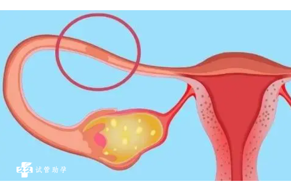 输卵管炎能做试管吗？是否会影响胚胎着床？