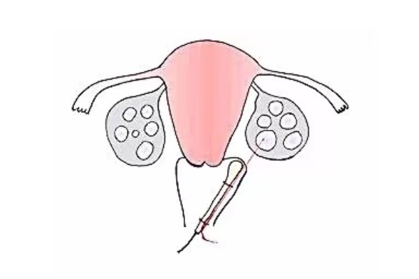 腹腔穿刺取卵流程公开，取卵后要注意这样护理