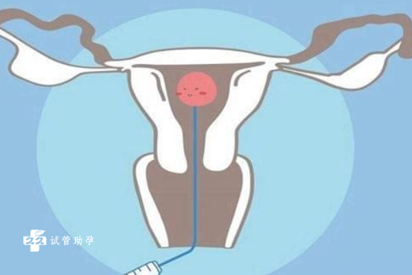 子宫内膜粘连在哪里做试管比较好？选择杭州还是北京？