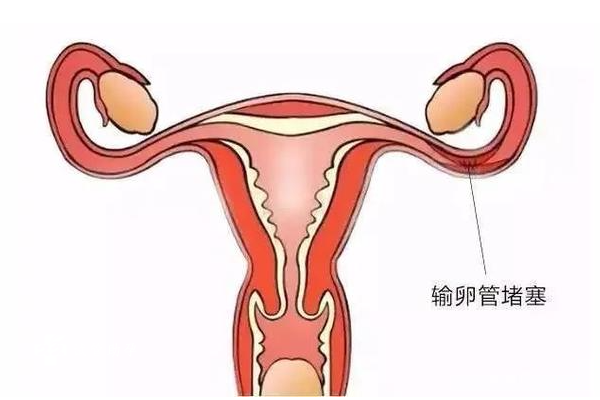 输卵管严重堵塞有什么征兆，教你判断和治疗输卵管堵塞的方法