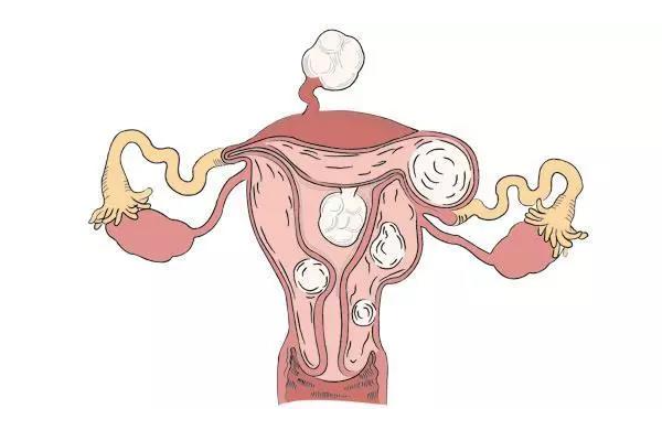 患有子宫肌瘤在乌克兰做试管能成功吗？成功率是多少？