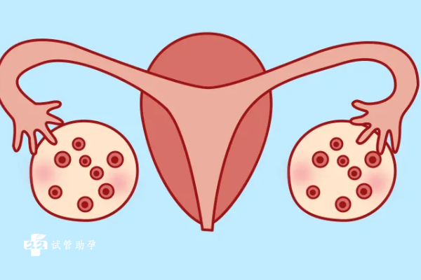 多囊卵巢如何治疗？可以预防吗？