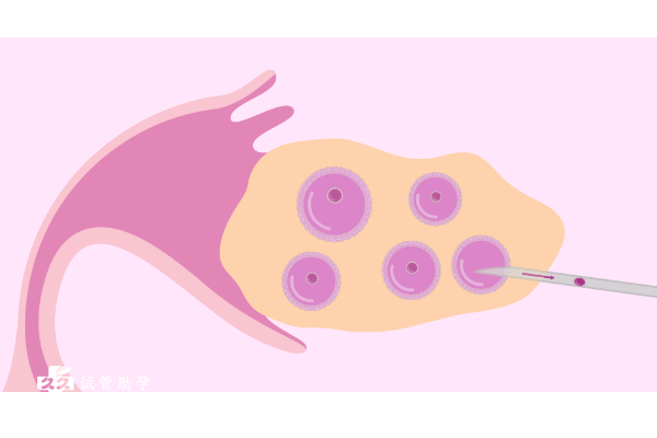卵巢发育不成熟做试管移植失败应该如何处理？