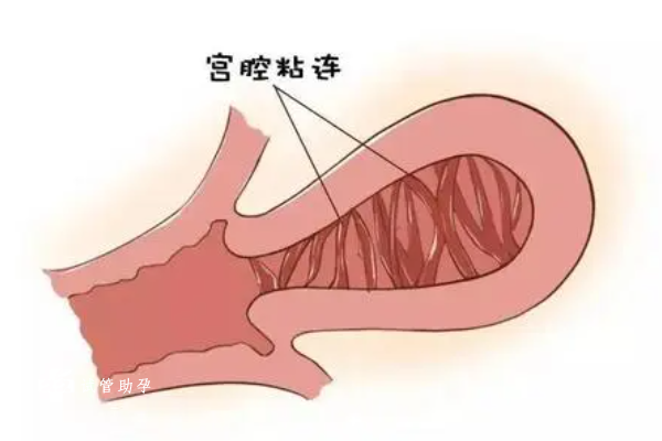 两次胎停后检查出宫腔粘连应该如何治疗？