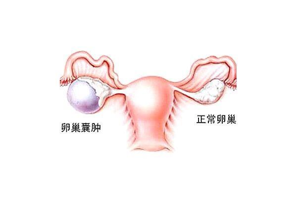 卵巢囊肿穿刺后多久可以做试管促排？