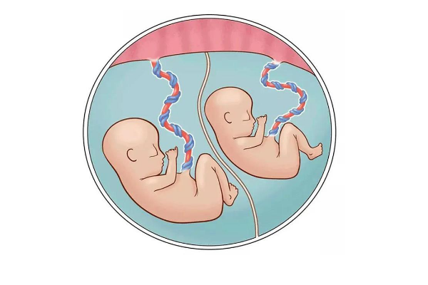 试管婴儿双胞胎做减胎的风险是什么？