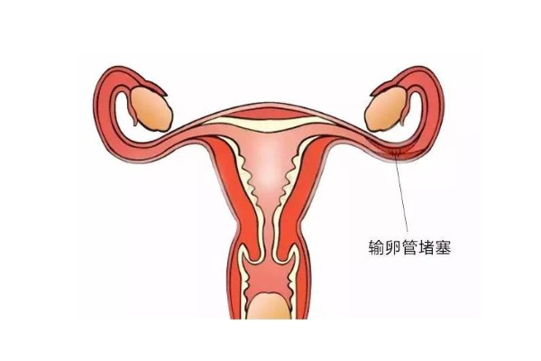 做完输卵管手术后多长时间可以开始备孕？